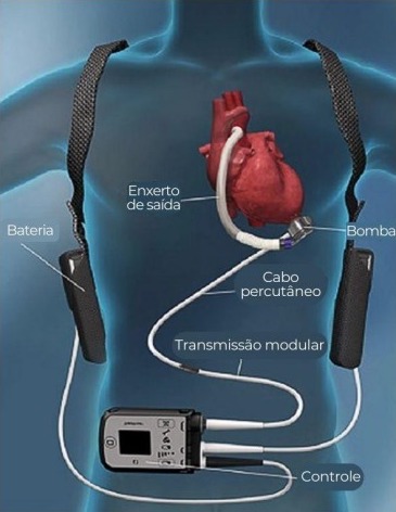Dispositivos de assistência ventricular